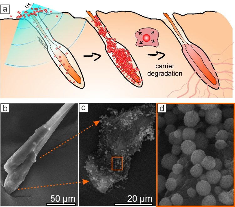 Доставка лекарств в волосяные фолликулы с помощью частиц ватерита. 
